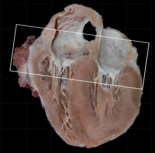 CAV in a pediatric age patient